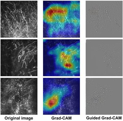 The Clinical Value of Explainable Deep Learning for Diagnosing Fungal Keratitis Using in vivo Confocal <mark class="highlighted">Microscopy Images</mark>